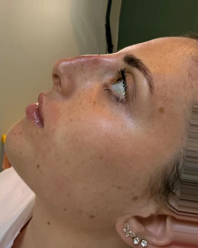 After non-surgical rhinoplasty treatment