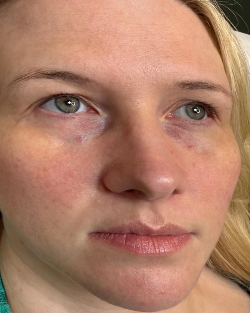 After tear trough under-eye filler treatment