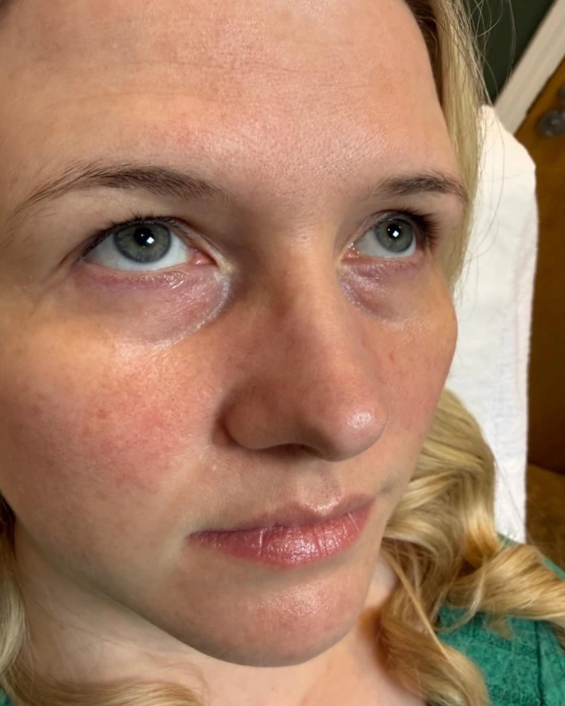 Before tear trough under-eye filler treatment