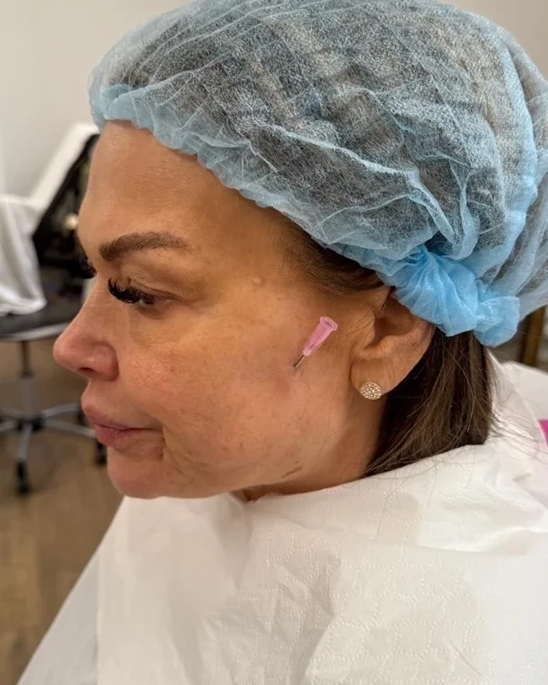 Before Ultimate Facelift treatment, client result two